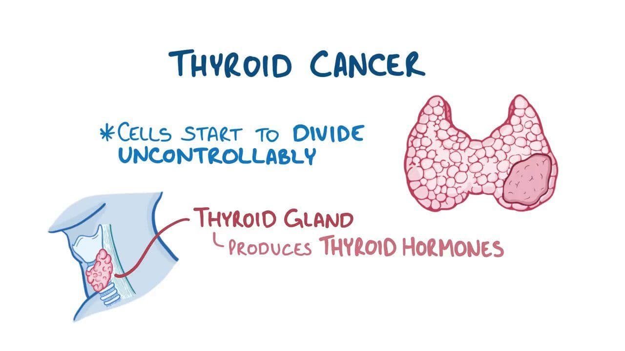 Fact Check: Thyroid cancer is a common type of endocrine cancer.