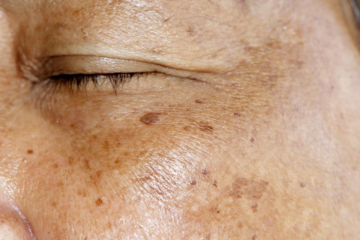 Fact Check: Are age spots dangerous?