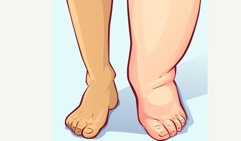 Fact Check: Swollen ankles in older adults indicate heart failure or dementia.