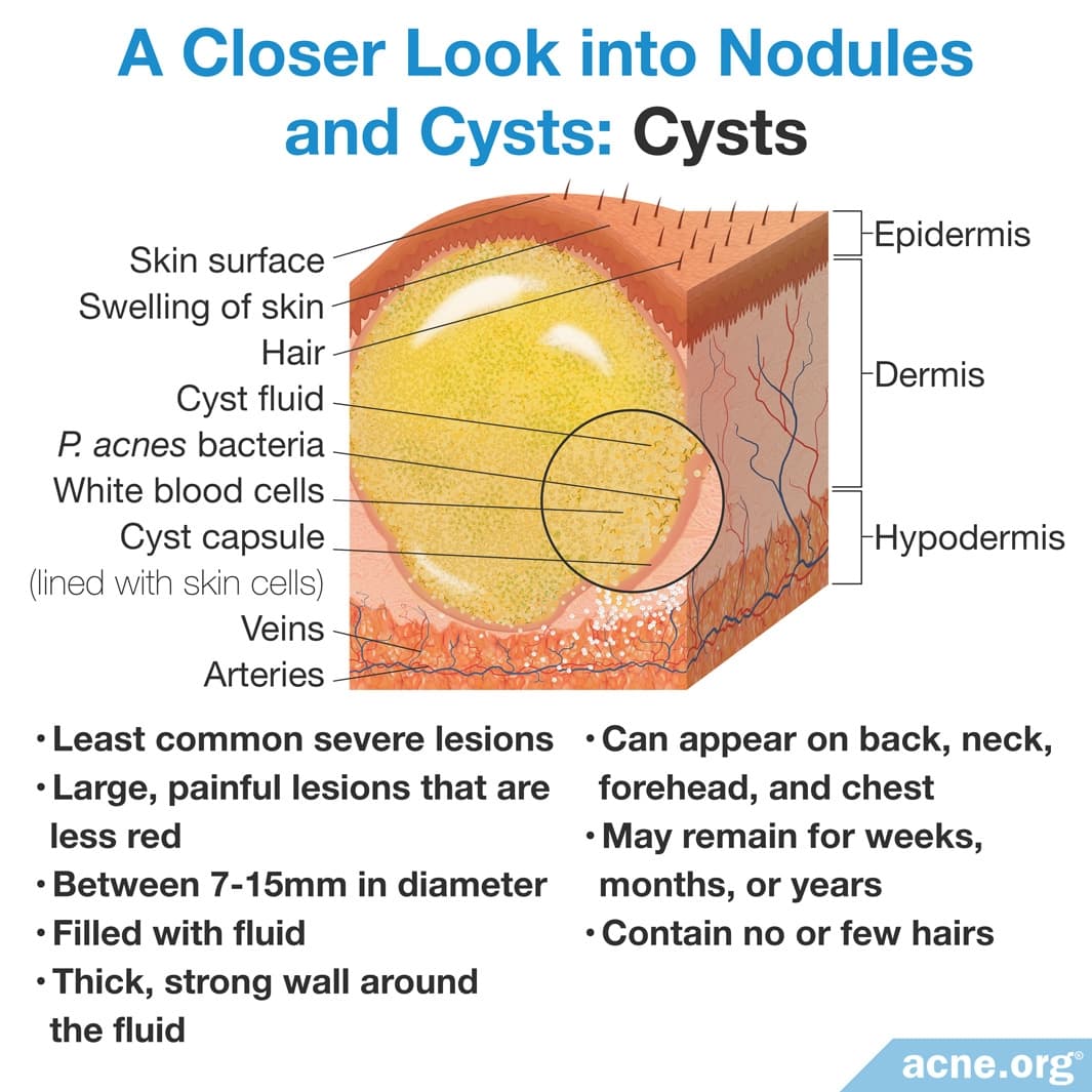 Fact Check: Are cysts hard?