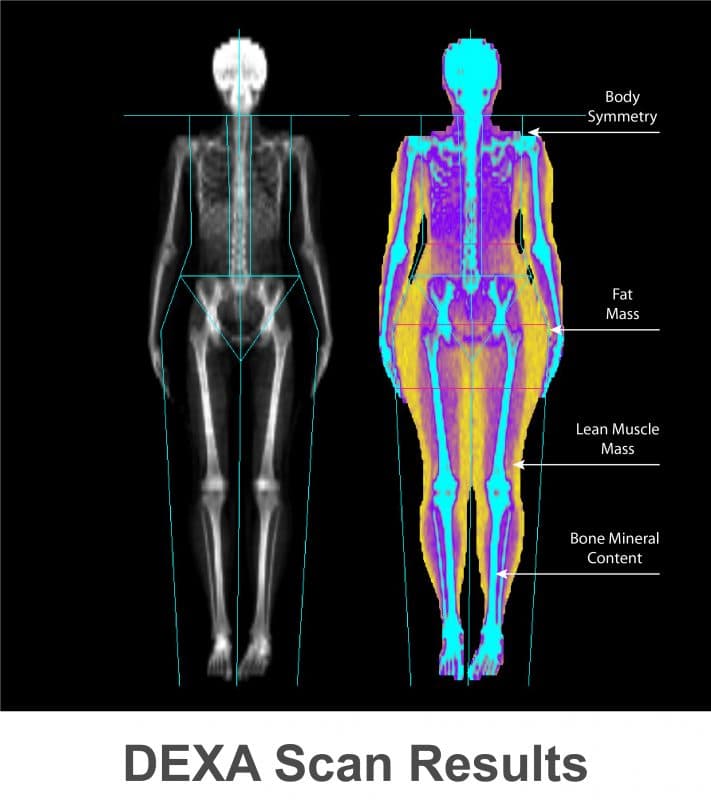 Fact Check: Are DXA scans accurate?