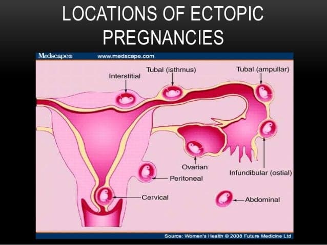 Fact Check: Are ectopic pregnancies common?