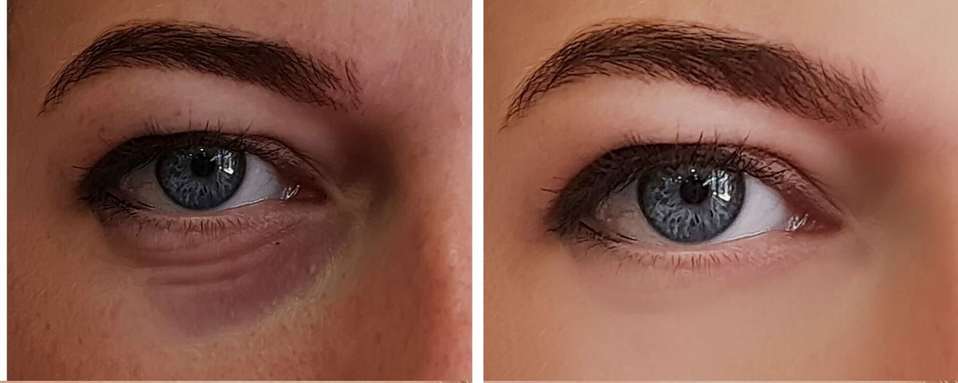 Fact Check: Are eyebags permanent?