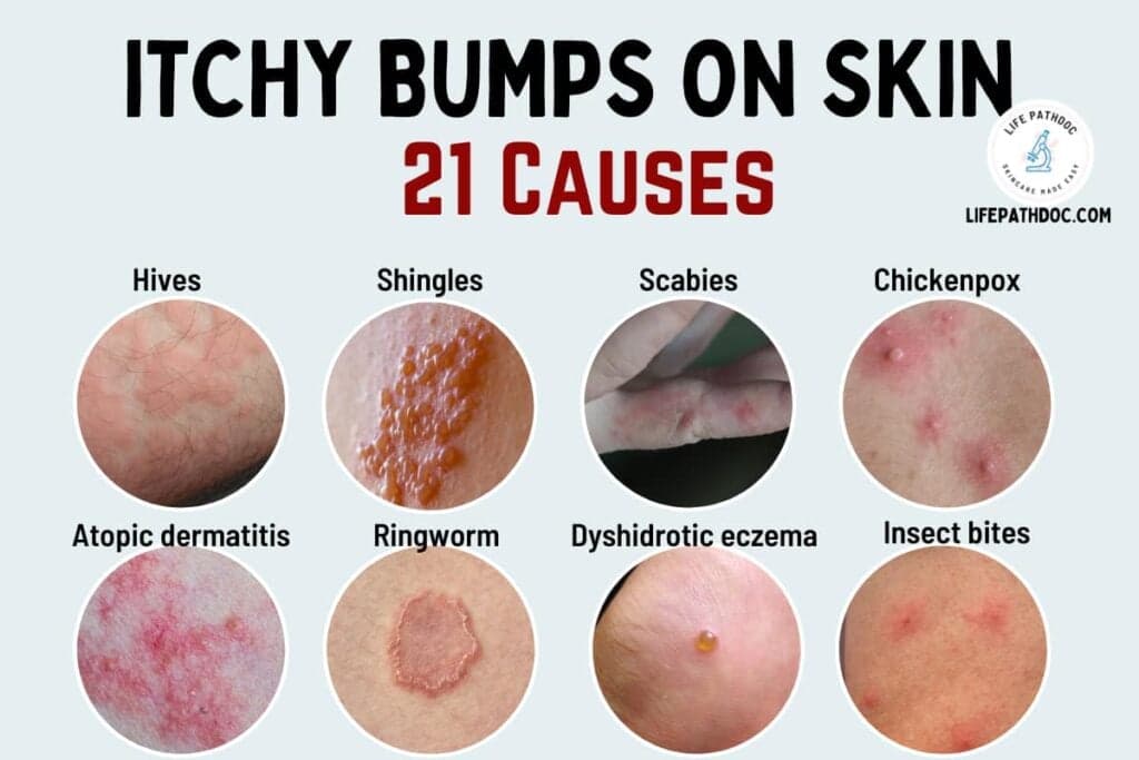 Fact Check: Are HFM bumps itchy?