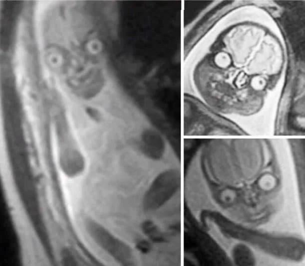 Fact Check: Are MRIs scary?