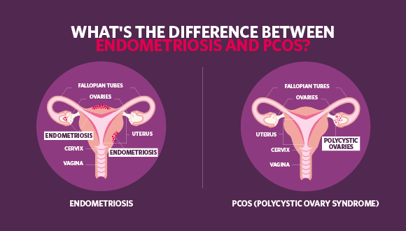 Fact Check: Are PCOS and endometriosis related?