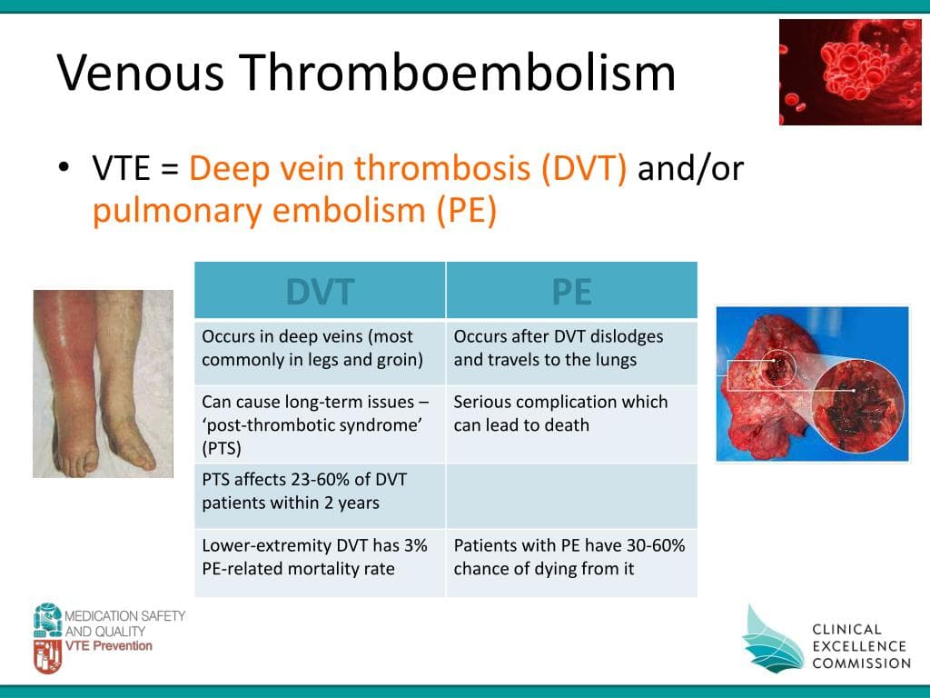 Fact Check: Are VTE and DVT the same?