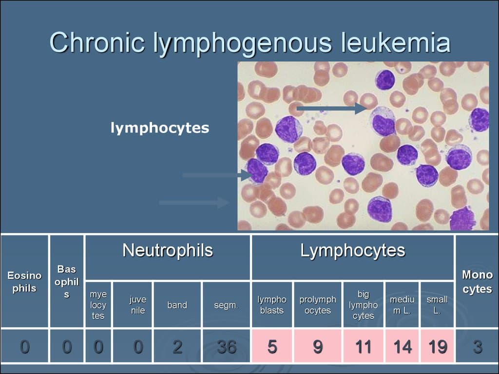 Fact Check: Are WBC high or low in leukemia?
