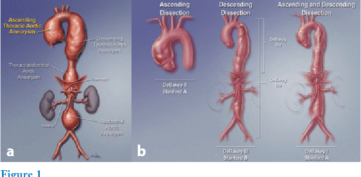 Fact Check: Are aortic aneurysms hereditary?
