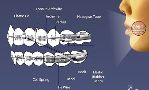 Fact Check: Are braces painful?