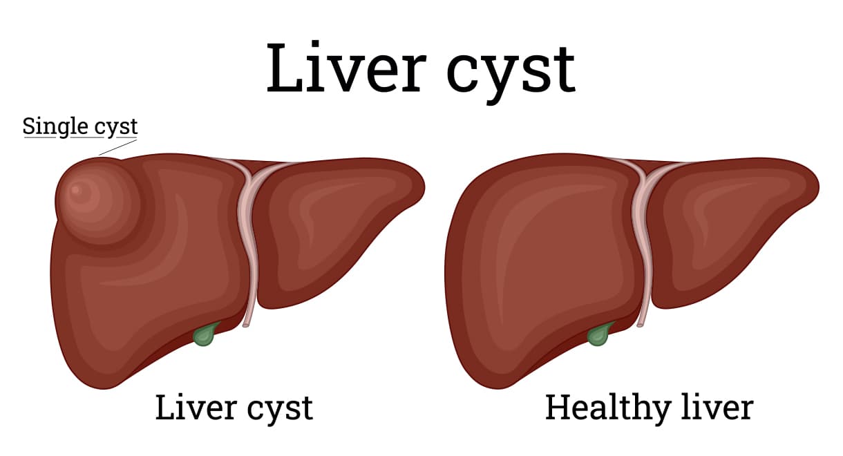Fact Check: Are cysts in the liver dangerous?