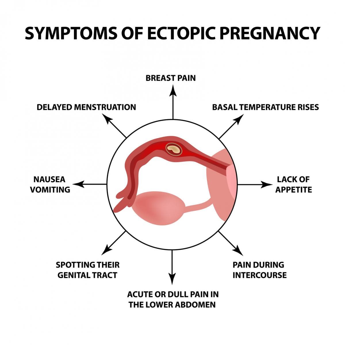 Fact Check: Are ectopic pregnancies viable?