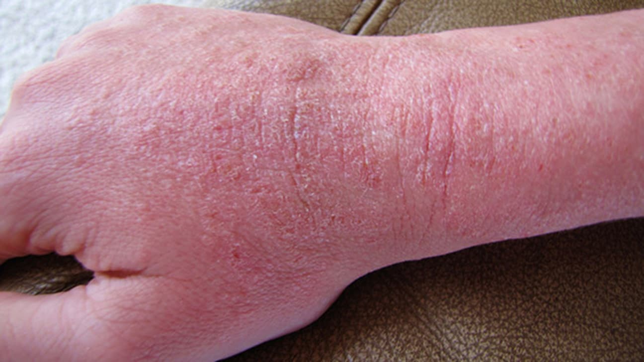 Fact Check: Are eczema itchy?