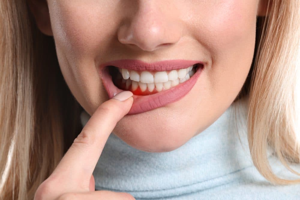 Fact Check: Can you get teeth disease though  kissing?