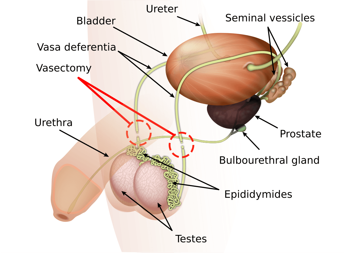 Fact Check: I had a vasectomy